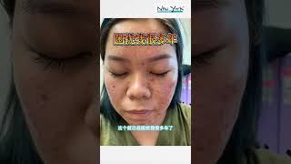 Customer Review  Joeys Acne Journey [upl. by Theobald]