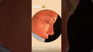 Female Rhinoplasty Result  By Dream Maker [upl. by Nauqal173]