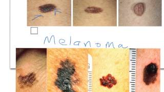 Nevi vs Melanoma [upl. by Ademordna192]