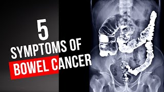 5 warning signs of Bowel Cancer you should NEVER ignore [upl. by Neva]