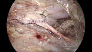 Retroperitoneoscopic pyeloplasty OR Setup port position and retroperitoneal access [upl. by Nezam]