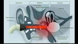 Tinnitool EarLaser Anwendung [upl. by Richey469]