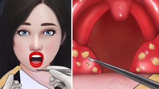 ASMR Cause of bad breath Extreme tonsil stone removal animation [upl. by Hilton236]