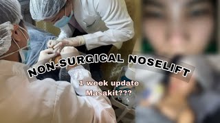 MY EXPERIENCE OF NONSURGICAL NOSELIFT namaga [upl. by Ellicott404]