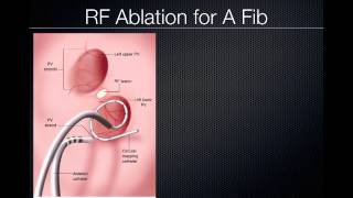 Pulmonary Vein Ablation Cardiac CT [upl. by Becki]