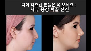 체부증강 턱끝 전진술 Body augmentation chin advancement surgery [upl. by Noinatrad192]