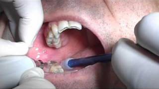 Third molars extraction without pliers and bleeding with piezosurgery in HD [upl. by Alveta]