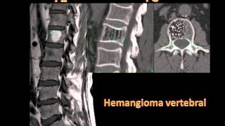 Hemangioma vertebral [upl. by Gardel]