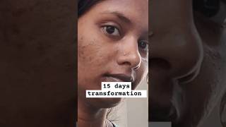 💯15 ദിവസം കൊണ്ട് എൻ്റെ skin ൽ Change കൊണ്ടു വന്ന facepack skintransformation acnejourney viral [upl. by Licna]