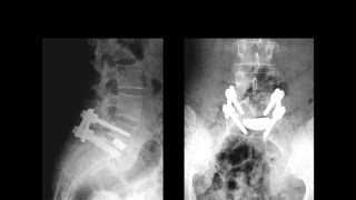 Operative Treatment of the Lytic Spondylolisthesis [upl. by Egidio]