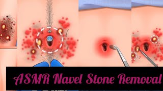 ASMR Body TreatmentsNavel Stone arms hair amp pimple remove treatment salon [upl. by Queri]