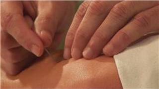 Acupuncture Treatments  Sciatica amp Acupuncture [upl. by Pollie19]