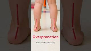 🚩These red flags could be indicators for pronation in your childs feet🚩 shorts [upl. by Htebi]