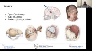 Virtual Cerebrovascular OR Dr Nitesh Patel quotIntraArterial Chemotherapy for Brain Tumorsquot [upl. by Jennica462]