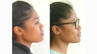 How Orthodontic Extractions can change Facial Profiles [upl. by Debby]