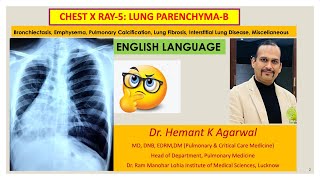 Radiology Chest X Ray5 ENGLISH Bronchiectasis Emphysema ILD Pulmonary EdemaDr Hemant [upl. by Rawna]