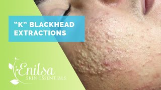 Blackheads Whiteheads Extractions on quotKquot Part 1 [upl. by Mavilia977]