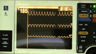 Ventricular Tachycardia [upl. by Boykins]