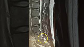 Lumbar Disc Herniation recovery at home discherniation discbulges backpain gym sciatica l5s1 [upl. by Aihsenek]