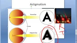 Ophthalmology 044 a Refractive Errors Of Refraction Emmetropia Ametropia Myopia HyperMetropia Eye [upl. by Attemaj]