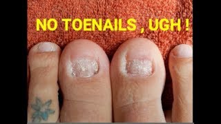 I have quot NO TOENAILS quot   Getting ready for NEW TOENAILS — More Info [upl. by Merna]