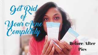 MDacne Review NOT SPONSORED With before and after pictures  How To Use The App  Skincare Routine [upl. by Nadirehs]