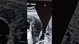 9 Weeks Pregnancy Ultrasound  9 Weeks Pregnancy Update  Bleeding During Pregnancy [upl. by Arfihs]