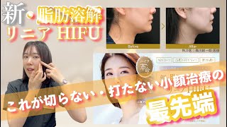 【切らずに美フェイスライン！？】若返り治療の名医が脂肪溶解リニアHIFUを徹底解説 [upl. by Auqinaj]