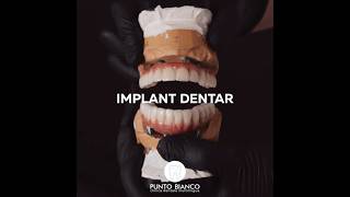 Tu de care implant dentar ai nevoie Clinica Punto Bianco  Chisinau Moldova [upl. by Bilicki]