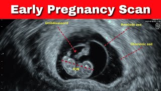 Early Pregnancy Scan Presentation  Dr Kunal Rathod [upl. by Mccafferty]