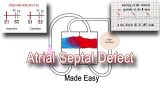 Understanding Atrial Septal Defect ASDA congenital defect atria heart asd congenital health [upl. by Fisk]