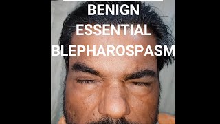 Benign essential blepharospasm BEB shorts [upl. by Nonez192]