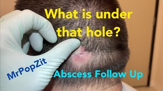 What is under that enlarged pore Large abscess follow up cyst has reformed and I cut it out [upl. by Rovit]