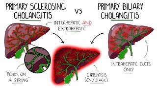 Primary Sclerosing Cholangitis v Primary Biliary Cholangitis Primary Biliary Cirrhosis [upl. by Aryt]