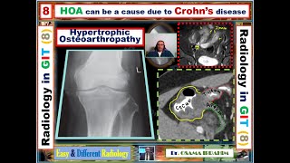 Hypertrophic OsteoArthropathy and Crohns disease [upl. by Assirroc]