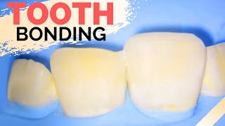 Teeth Bonding Procedure  Front Tooth Filling to Repair Chipped Tooth [upl. by Gilud]