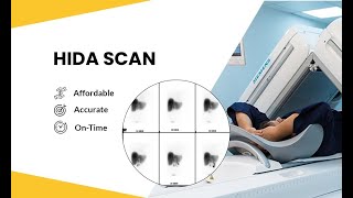 Bile Scintigraphy  Hepatobiliary Iminodiacetic acid Scan HIDA SCAN [upl. by Liauqram]