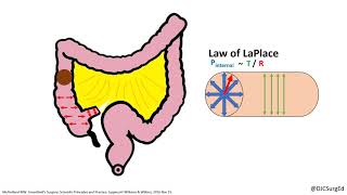 Colonic Volvulus [upl. by Hasan]