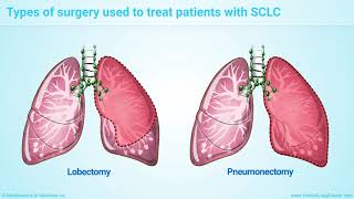 Treatment and Management of Small Cell Lung Cancer SCLC [upl. by Nozicka]