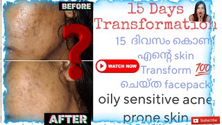 ✅15 Days Skin Transformation Videoskintransformers skintransformation skintransformationchallenge [upl. by Llenyr]