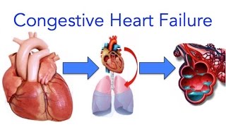 Congestive Heart Failure CHF Explained  MADE EASY [upl. by Fia]