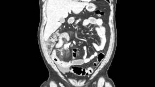 Carcinoid tumor in mesentery with desmoplastic reaction [upl. by Nalrah]