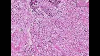 Histopathology BreastLobular carcinoma [upl. by Neelat308]